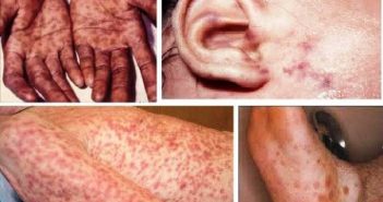 Biểu hiện bệnh giang mai ở nam và nữ